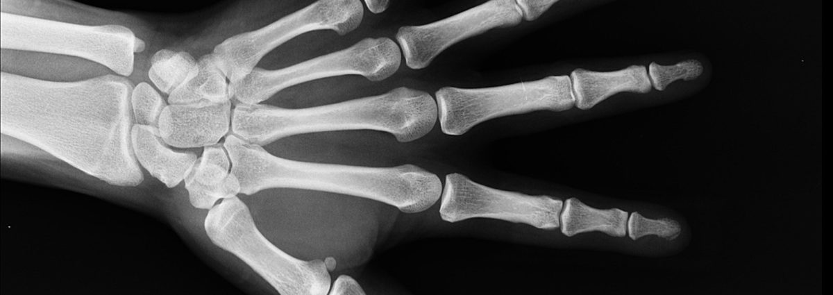 X-Ray of Hand